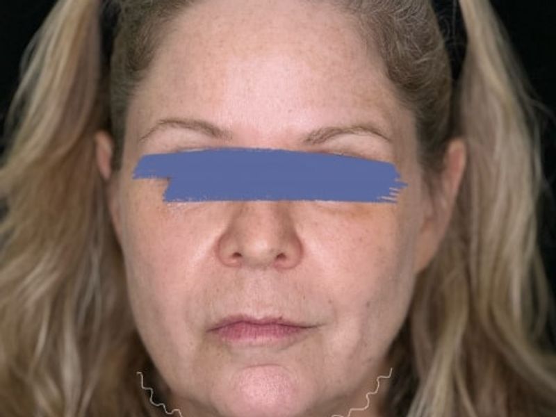 Before Female Jawline PDO thread lift procedure at our Montreal, Quebec aesthetic clinic (frontal view)