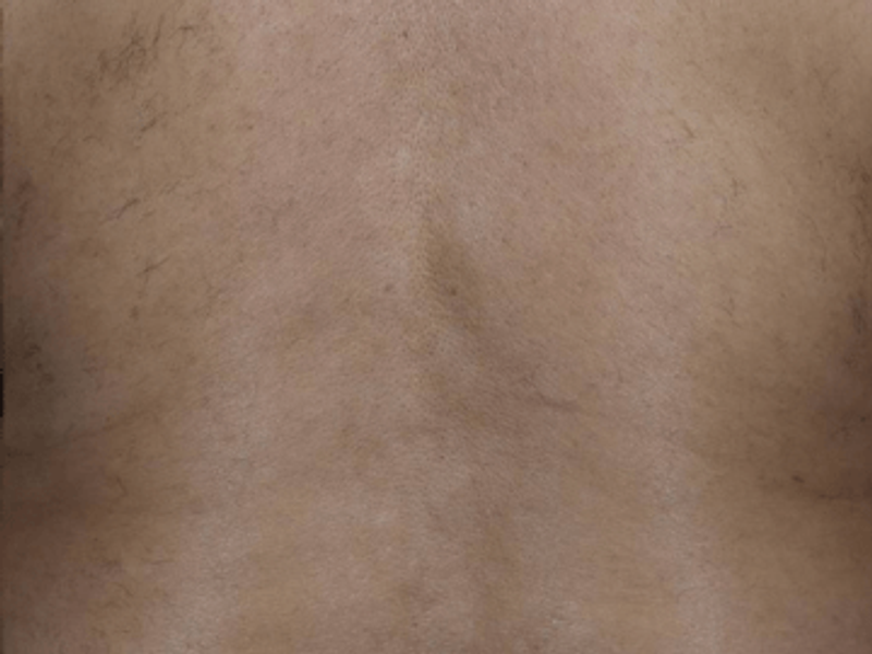 Back laser hair removal after Excel HR treatment in Montreal