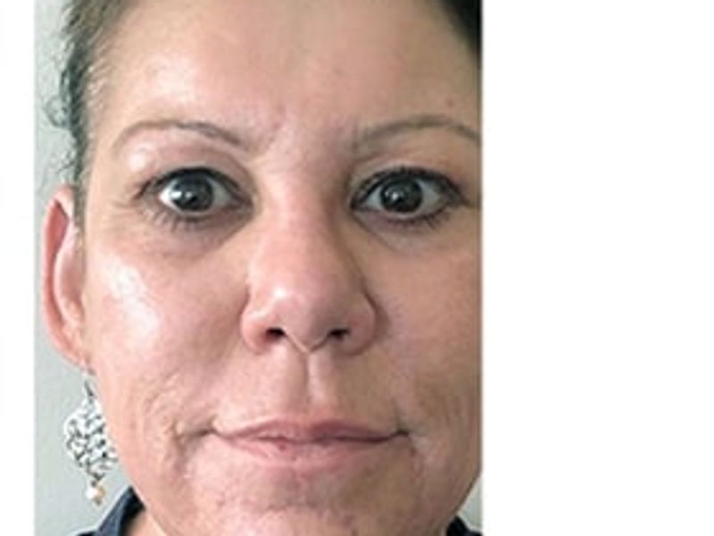 Patient after Scarlet-S RF treatment for wrinkles - Ideal Body Clinic Montreal