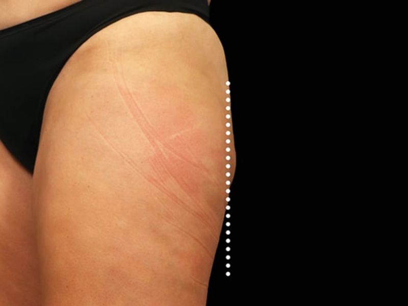 Thigh bulge After Emsculpt NEO Body Contouring fat removal therapy in Montreal