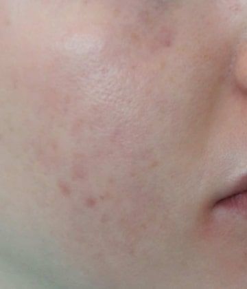 After Secret Pro by Cutera for acne - Montreal