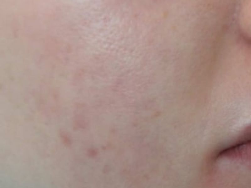 After Secret Pro by Cutera for acne - Montreal