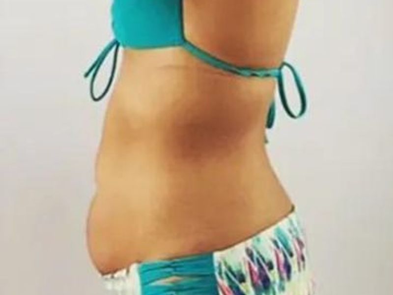 Belly fat Before Slimwave Montreal treatment at Ideal Body Clinic
