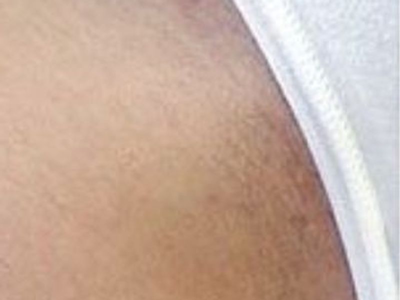 After bikini laser hair removal treatment in Montreal