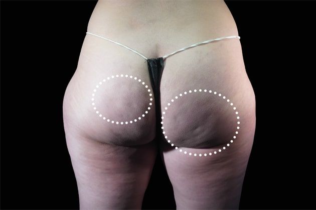 Butt cellulite Before Emsculpt NEO Body Contouring fat removal therapy in Montreal