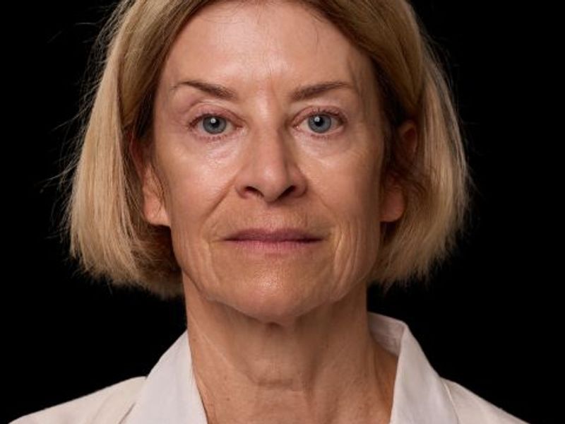 Before picture: triLift treatment for mature woman in Montreal at Ideal Body Clinic