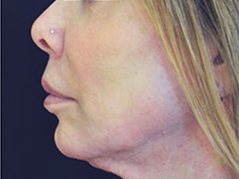 Patient after chin Scarlet-S RF treatment - Ideal Body Clinic Montreal