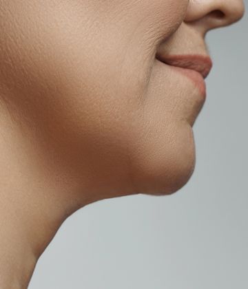 Fat-dissolving injection Treatments for double chin in Montreal After pictures