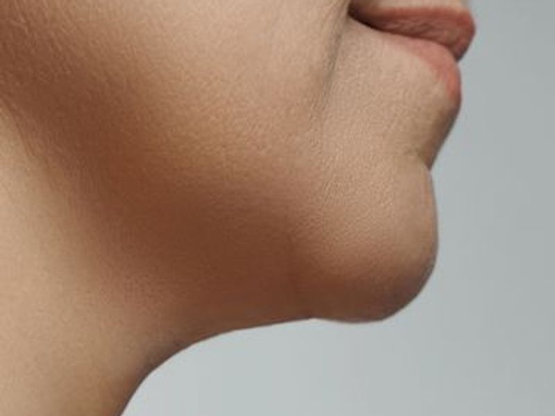 Fat-dissolving injection Treatments for double chin in Montreal After pictures