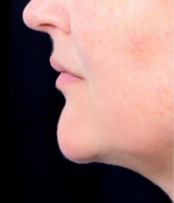 After Fat-dissolving injection Treatments for double chin in Montreal
