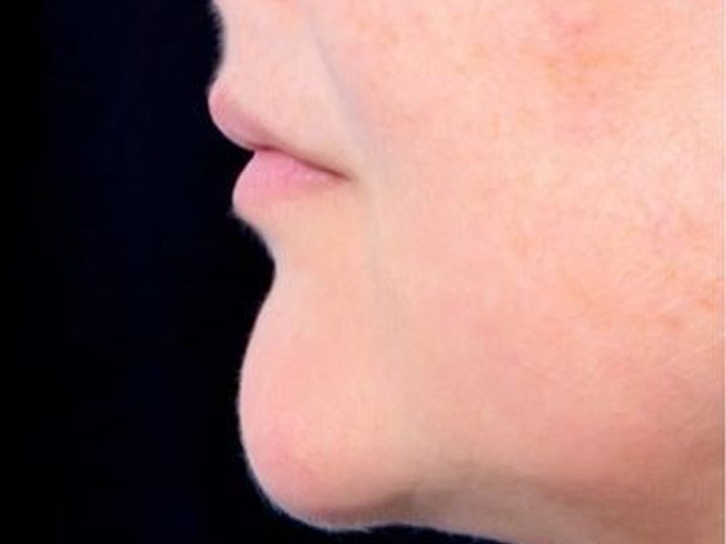 After Fat-dissolving injection Treatments for double chin in Montreal