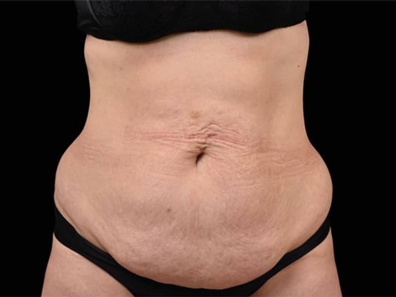 Sagging belly fat Before Emsculpt NEO Body Contouring fat removal therapy in Montreal