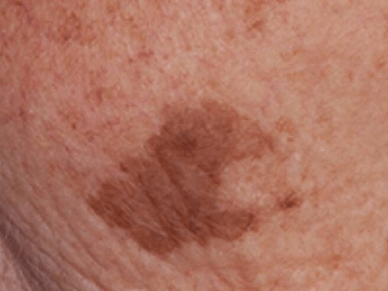 Facial pigmented lessions removal after Excel HR treatment in Montreal