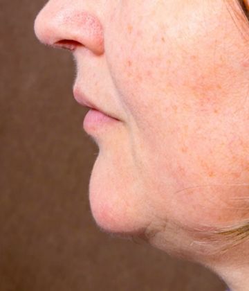 Before Fat-dissolving injection Treatments for double chin in Montreal