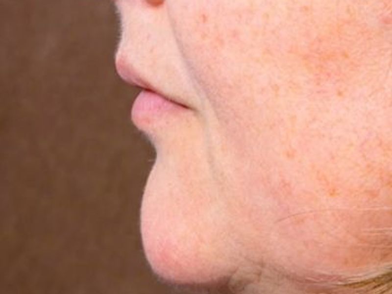 Before Fat-dissolving injection Treatments for double chin in Montreal