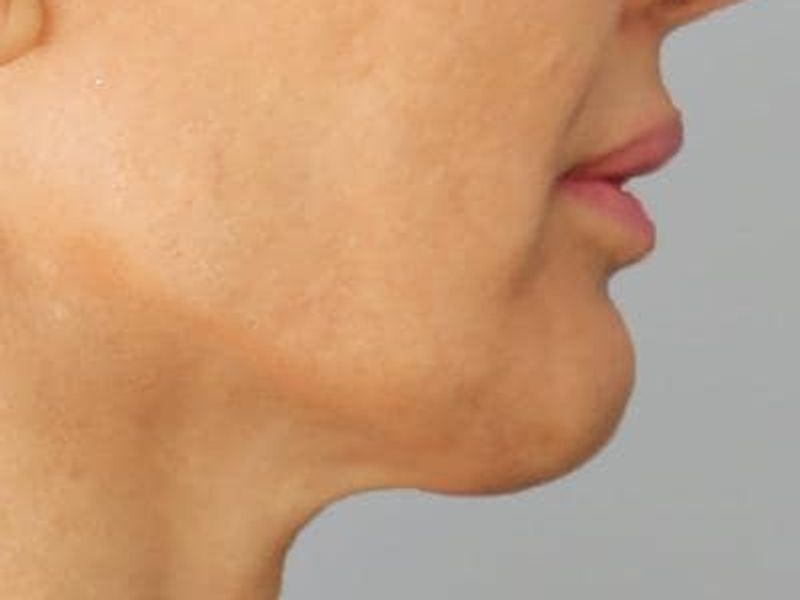 Before double chin Profound Radiofrequency Microneedling Skin treatment - Montreal