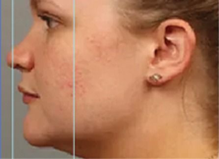 Side profile of a patient's cheek with visible red blemishes before exosomes after microneedling.