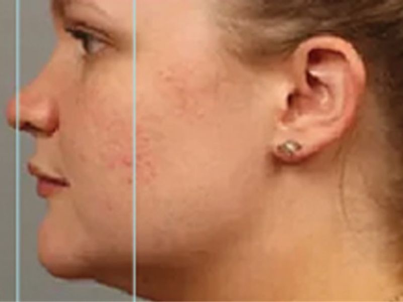Side profile of a patient's cheek with visible red blemishes before exosomes after microneedling.