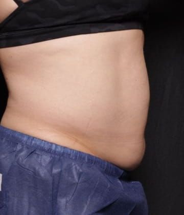 Before fat abdomen picture Venus Bliss Max Contouring in Montreal