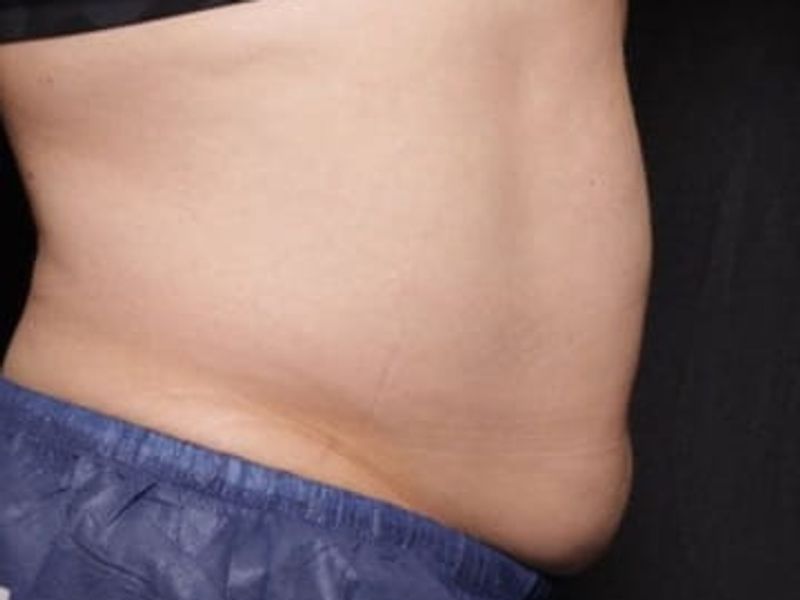 Before fat abdomen picture Venus Bliss Max Contouring in Montreal