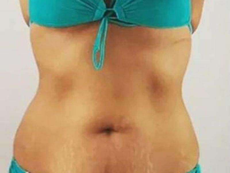 Love handles Before Slimwave Montreal treatment at Ideal Body Clinic