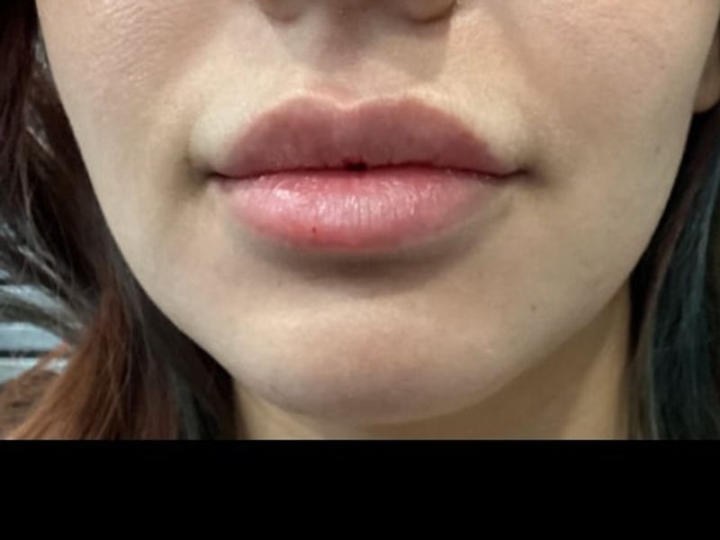 Before Female Lip Fillers procedure at our Montreal aesthetic clinic