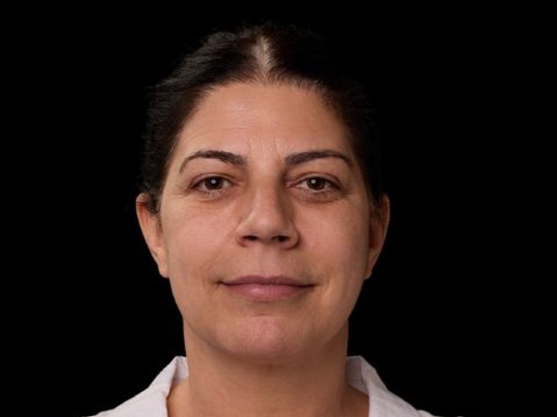 Before picture: trilift under the eye treatment in Montreal