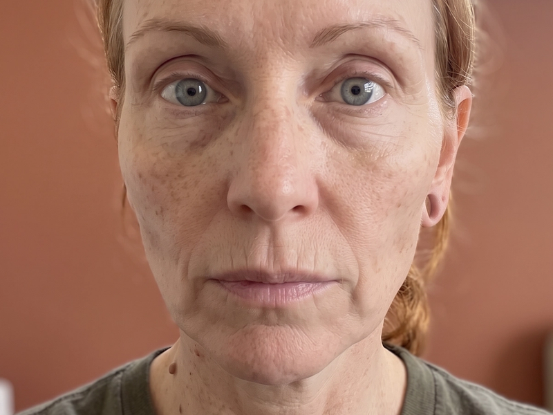 The same patient photographed at a later visit, from the same angle and under the same lighting.