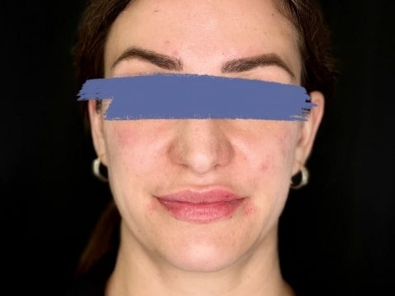 After Female Cheeks and Lips Dermal Fillers procedure at our Montreal aesthetic clinic