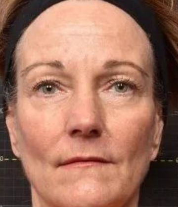 After Face Sofwave Treatment Picture in Montreal