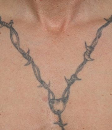 Before CUTERA Enlighten Tatto Removal Montreal, chest picture