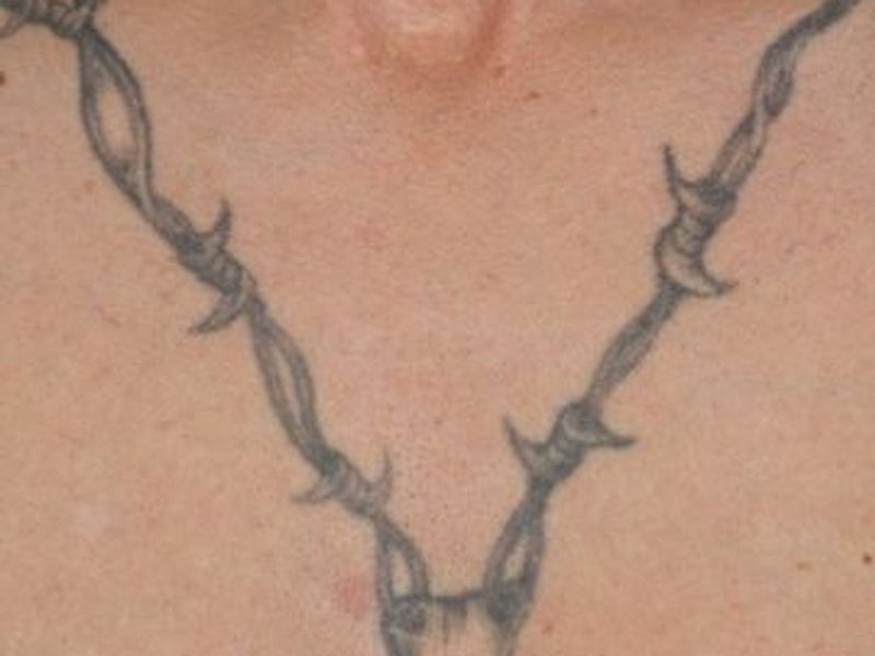 Before CUTERA Enlighten Tatto Removal Montreal, chest picture