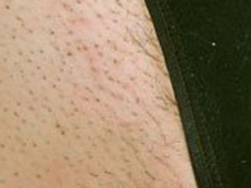 Before bikini laser hair removal treatment in Montreal