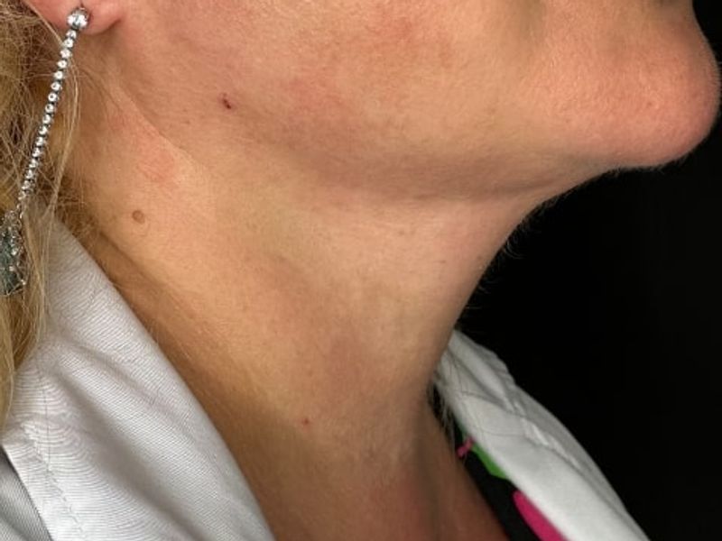 After Female Neck Lines Dermal Fillers procedure at our Montreal aesthetic clinic