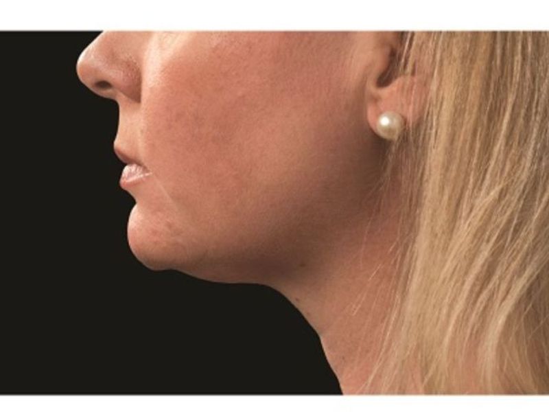 Sagging double chin After CoolSculpting Body Contouring fat loss Treatment in Montreal