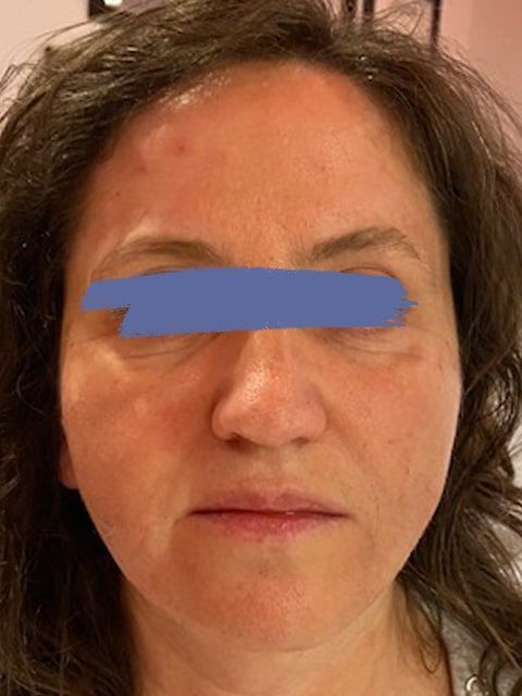 Female marionette lines after PDO thread lift procedure at our Montreal, Quebec aesthetic clinic