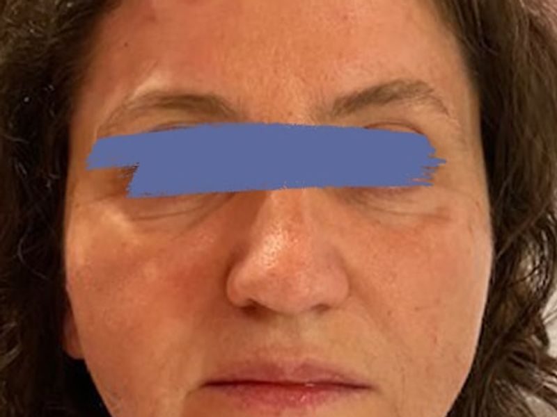 Female marionette lines after PDO thread lift procedure at our Montreal, Quebec aesthetic clinic