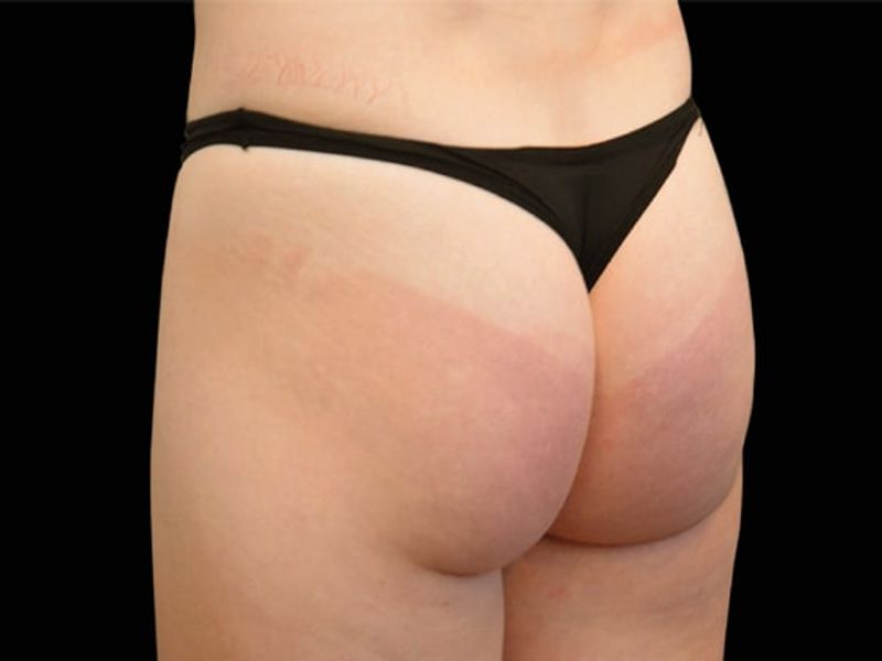Butt lift Before Emsculpt NEO Body Contouring fat removal therapy in Montreal