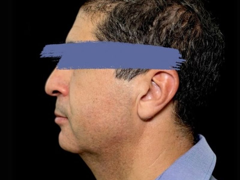 Before Male Jawline Fillers procedure at our Montreal aesthetic clinic