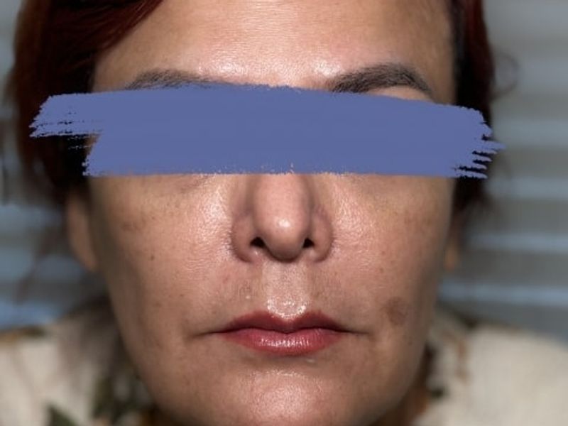 Before Male Lip Fillers procedure at our Montreal aesthetic clinic