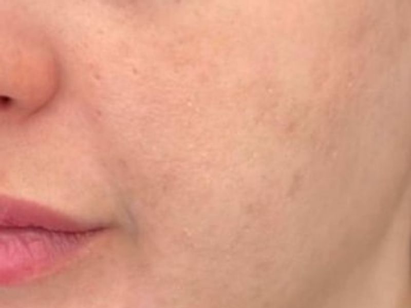 After Secret Pro by Cutera for acne and acne scars - Montreal