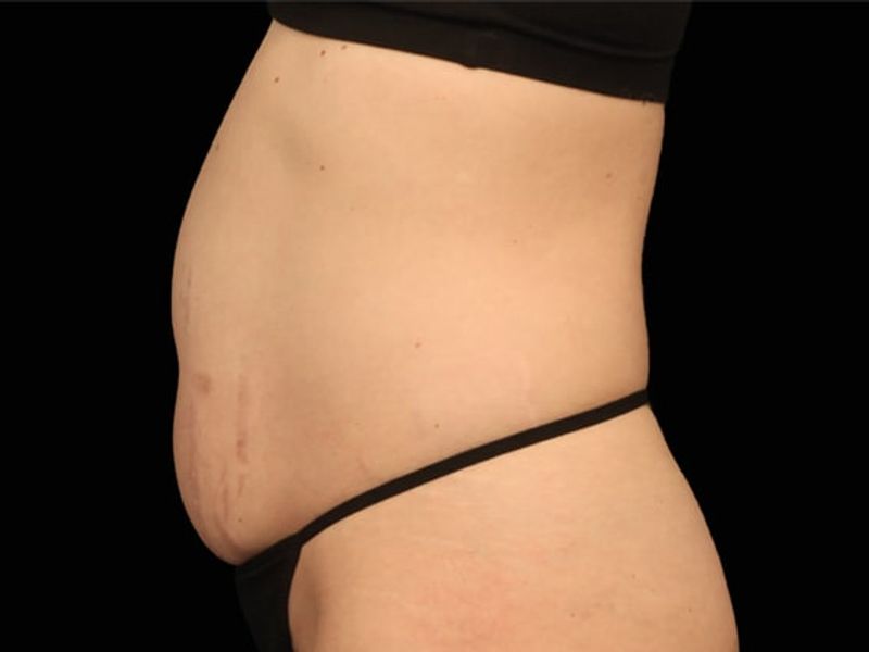 Stubborn belly fat Before Emsculpt NEO Body Contouring fat removal therapy in Montreal
