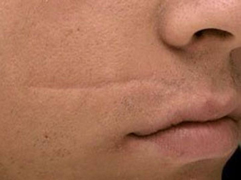 Before Fotona Laser Skin Treatment for scar removal - Montreal