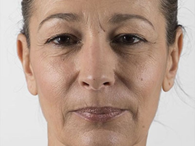 After Aesthetic Hyaluronic acid dermal fillers injectables in Montreal