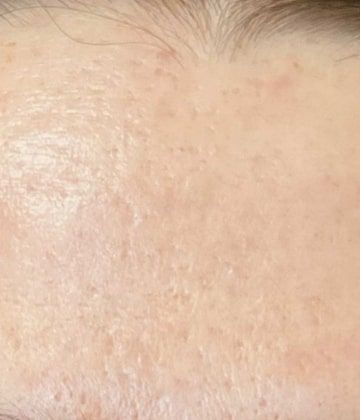 After Secret Pro by Cutera for forehead skin - Montreal
