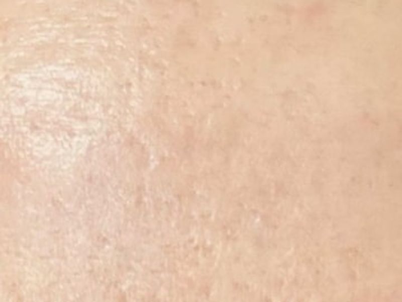 After Secret Pro by Cutera for forehead skin - Montreal