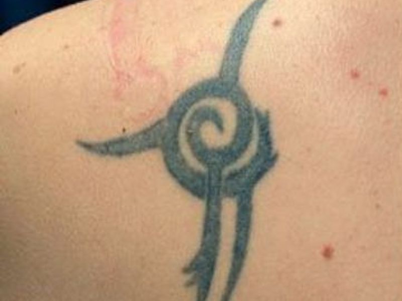 Before Fotona Laser Skin tattoo removal - Montreal