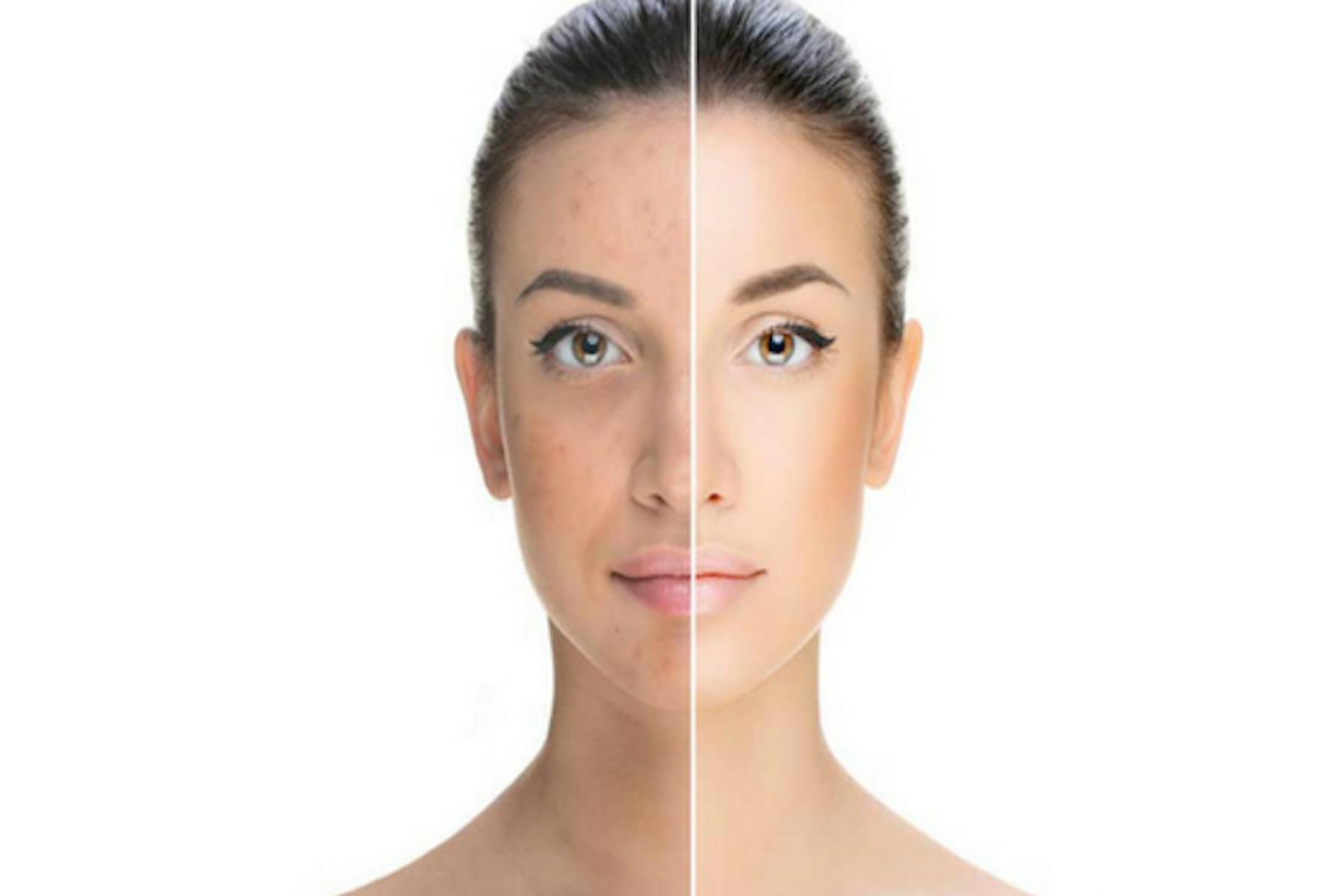 Revive Your Complexion: Advanced Protocol for Melasma and Acne
