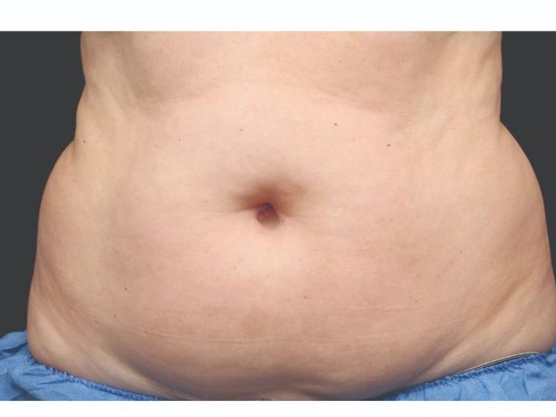 Belly fat Before CoolSculpting Body Contouring fat loss Treatment in Montreal