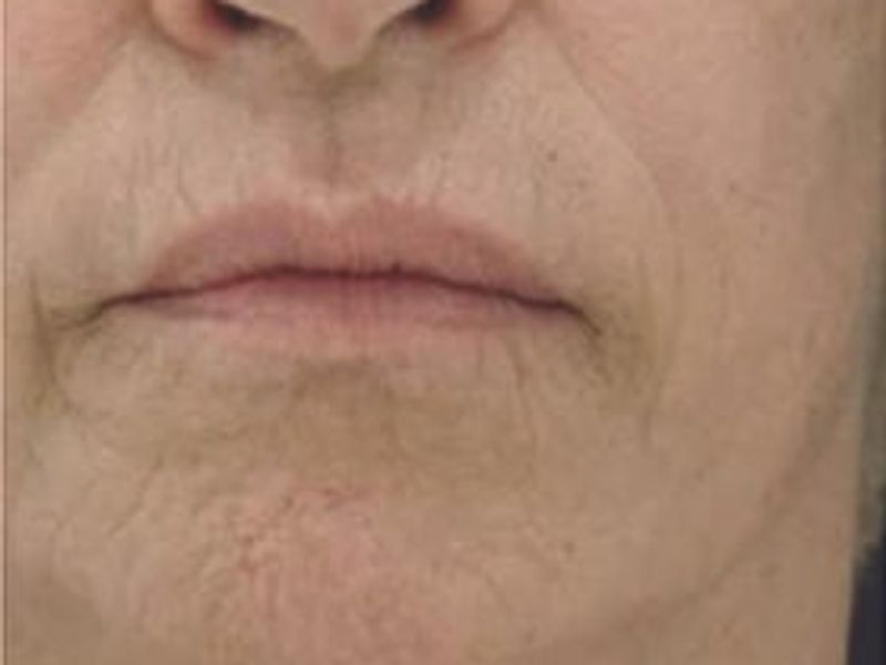 Patient before Scarlet-S RF treatment for mouth - Ideal Body Clinic Montreal
